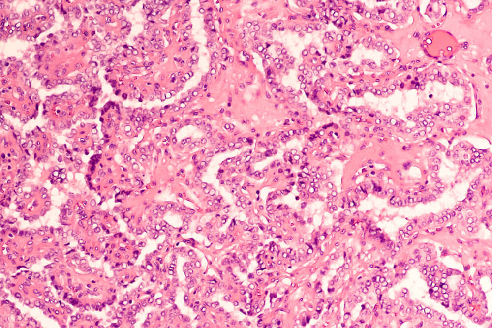 Microscopic image of papillary thyroid carcinoma
